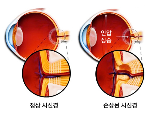 녹내장